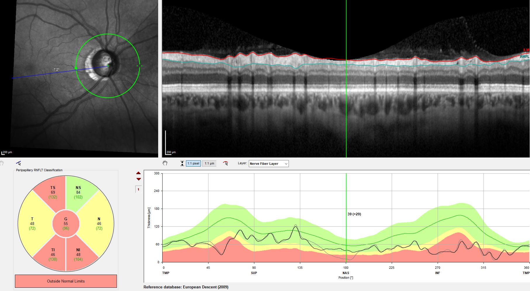 Augenklinik Castrop-Rauxel Grüner Star