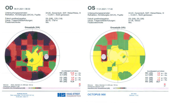 Augenklinik Castrop-Rauxel Grüner Star