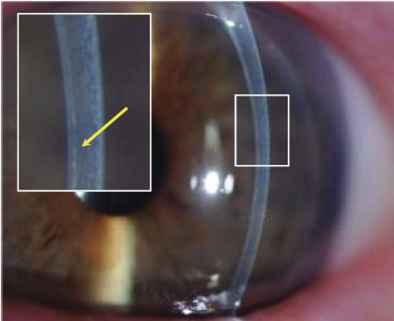 Augenklinik Castrop-Rauxel Hornhauttransplantation