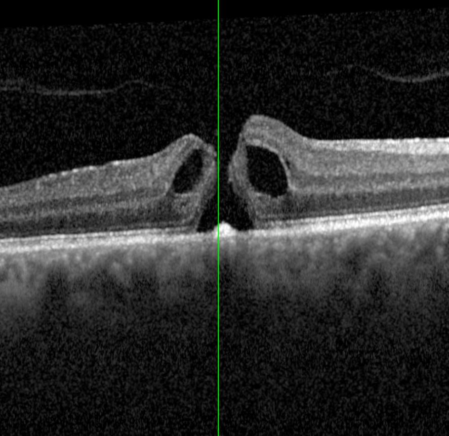 Augenklinik Castrop-Rauxel Netzhautchirurgie